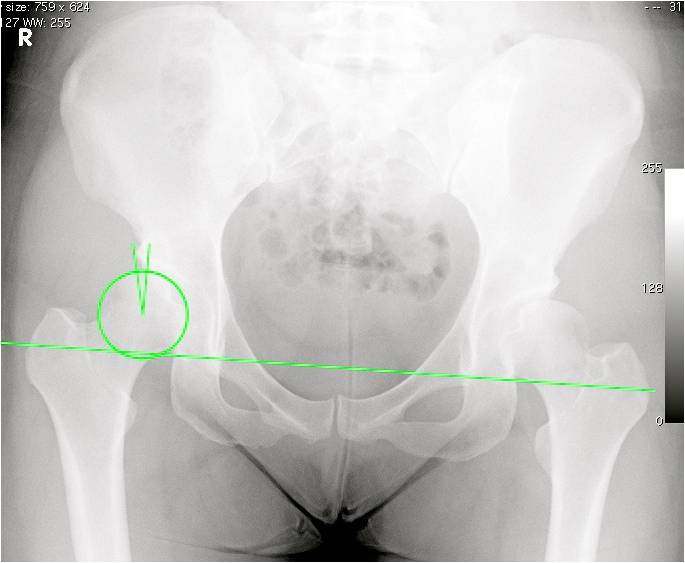 Acetabular Dysplasia FAQs Hip and Pelvis Doctor Articles Asia